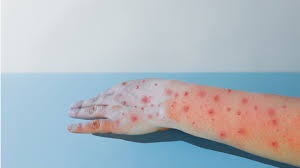 اولین مورد از نوع جدید ویروس امپاکس در ایرلند شناسایی شد اولین مورد از نوع جدید ویروس امپاکس در ایرلند شناسایی شد