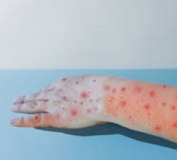 اولین مورد از نوع جدید ویروس امپاکس در ایرلند شناسایی شد