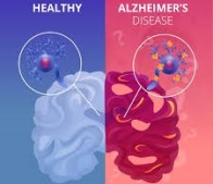 آزمایش خون جدید می‌تواند به تشخیص آلزایمر و ارزیابی میزان پیشرفت آن کمک کند